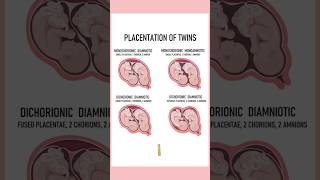 4 Types of twins medically Twin pregnancies pregnant youtubeshorts twins September 4 2024 [upl. by Ardnait]