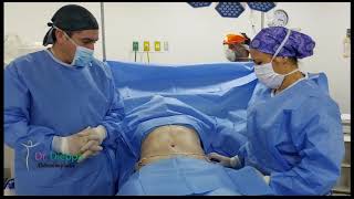 Cirugía Abdominal Abdominoplastia con Lipoescultura [upl. by Palestine]