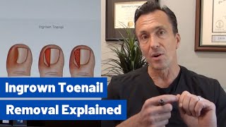 Ingrown Toenail Removal Dr Moore Explains the Permanent Cosmetic Procedure [upl. by Danny671]