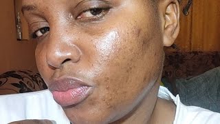 MY TRETINOIN JOURNEY TWO WEEKS UPDATE [upl. by Hada]