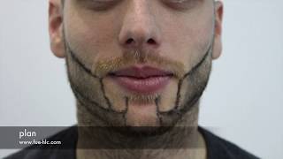 Beard Transplant Beard to Beard Transplant Hairline Clinic [upl. by Essilec]