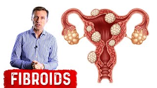 The Best Foods to Shrink Fibroids [upl. by Merat]