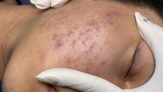 ACNE TREATMENT VU QUYNH MI Acne On Boys Cheek 2024 [upl. by Arika]