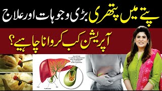 Gallstones Causes and Treatment  Dr Fareeha Tariq [upl. by Miller793]