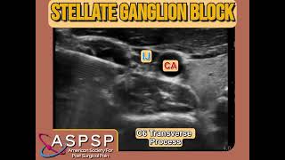 Ultrasound Guided Stellate Ganglion Block [upl. by Winnifred333]