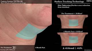 SculpSure for Submental Fat Reduction Under the Chin Fat [upl. by Flodnar]