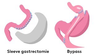 Quelles sont les techniques de chirurgie de lobésité [upl. by Nalrah237]