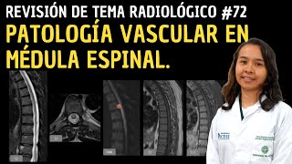 Revisión de tema 72 Patología vascular en médula espinal [upl. by Nimrahc]