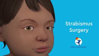 What is Strabismus Surgery [upl. by Mohammad]