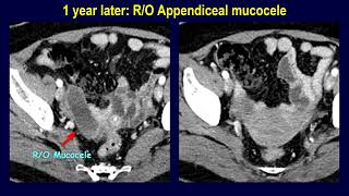 Appendiceal mucocele or mucinous neoplasm  Naming determines the management [upl. by Ekyt]