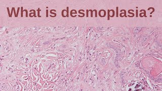 What is Desmoplasia  Pathology mini tutorial [upl. by Simonetta]