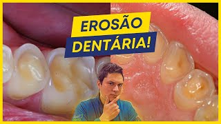 COMO TRATAR A EROSÃO DENTÁRIA [upl. by Loren]