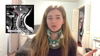 Diagnostic Testing for Craniocervical Instability CCI and Atlantoaxial Instability AAI [upl. by Morrell]