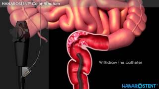 Hanaro Colonic Stent Demonstration Video [upl. by Reteid]