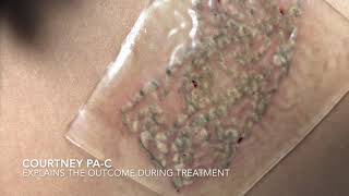 Laser Tattoo Removal with PFD Patch and Results [upl. by Lebiram]