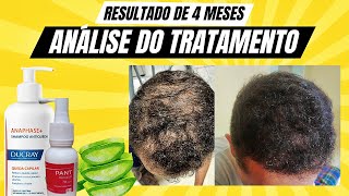 ANÁLISE DO TRATAMENTO RESULTADO DE 4 MESES Queda de cabelo e calvície masculina [upl. by Ameh935]