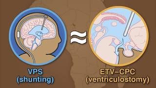 Treatment for Postinfectious Hydrocephalus in Infants [upl. by Ahsenra912]