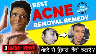 4 Step PIMPLE Removal At Home  GOODBYE ACNE  Ranveer Allahbadia [upl. by Alis460]