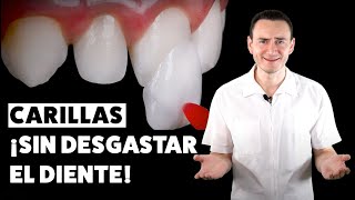 Carillas dentales ¡SIN DESGASTE Una excelente opción  CASO REAL [upl. by Assirk391]