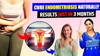 Natural Ayurvedic Home Remedies for Endometriosis  Ayurvedic Treatment for Endometriosis [upl. by Thorsten]