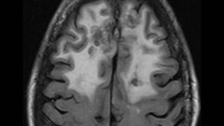 Intracranial Apergillosis [upl. by Arah]