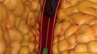 Peripheral Thrombectomy Animation [upl. by Hultgren]