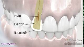 Interproximal Reduction Showing Cross Section  Orthodontic Treatment [upl. by Evad382]