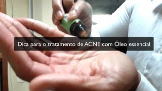 Tratamento ACNE com Óleo de Melaleuca [upl. by Letisha835]