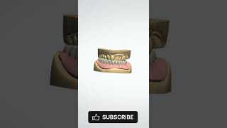 Lower Partial Denture partialdenture dentalprosthesis [upl. by Anenahs]