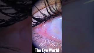 conjunctival cyst [upl. by Elocan]