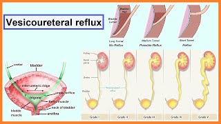 vesicoureteral reflux [upl. by Nangem498]