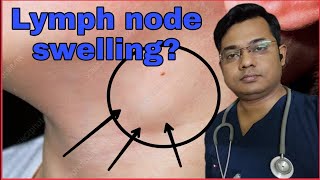 Causes of lymph node swelling and treatmentLymphomaDoctor on YouTube glandswelling [upl. by Dorry]