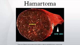 Hamartoma [upl. by Bonnice128]