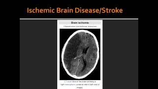 Ischemic Brain DiseaseStroke [upl. by Lagas221]