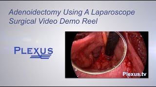 Adenoidectomy Surgical Video [upl. by Jillane731]