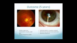 Scleral Lens Indications [upl. by Aphrodite]