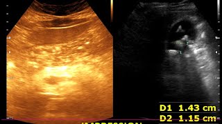 Cholelithiasis  Cholesterol polyp Moderate diffuse fatty Liver  Renal cortical cyst [upl. by Jarv308]