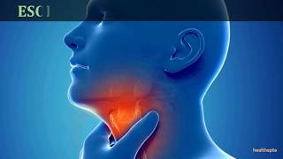 SYMPTOMS AND SIGNS OF ESOPHAGEAL CANCER [upl. by Otcefrep]