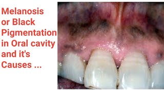 Smokers Melanosis Melanosis in mouth Melanosis in Lichen planus Melanosis in addisons disease [upl. by O'Shee473]