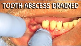 Infected Tooth Abscess Drained  Graphic⚠️ [upl. by Eceinaj]