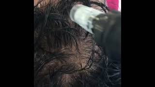 Intradermoterapia para paciente con alopecia  Dermatóloga en Cali [upl. by Norby]