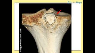 OSTEOLOGIE DU MEMBRE INFERIEUR [upl. by Malim]