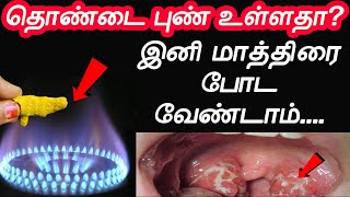 என் பாட்டி கை வைத்தியத்தால் எனக்கு சரியானது  thondai pun maruthuvam  Throat Pain  thondai vali [upl. by Johan878]