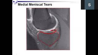 1 Knee MRI basics class BY Dr Samantha sir JOINTS PG Teaching Nashik [upl. by Leno]