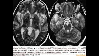 70 CADASIL Notch3 arteriopathy pericyt blood brain barrier anterior temporal pole stroke [upl. by Assirol]