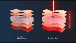 Hoạt ảnh điều trị của UltraClear  Laser Vi Điểm Quang Sợi Lạnh Đầu Tiên Trên Thế Giới [upl. by Eeleimaj]