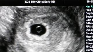 1st ultrasound at 5 weeks amp 4 days [upl. by Maryanne]