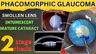 Phacomorphic glaucoma amp Intumescent mature cataract with swollen lens 2stage rhexis  Dr Deepak M [upl. by Ecnedac529]