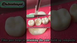 FULL PROCESS OFTOOTHCAVITYRESTORATIONbdshorts dentaldoctor dentist dentistdoctor dental [upl. by Pass]