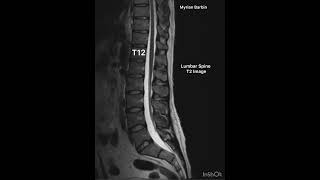 MRI Lumbar Spine anatomy diagnosticradiology mri [upl. by Galliett]